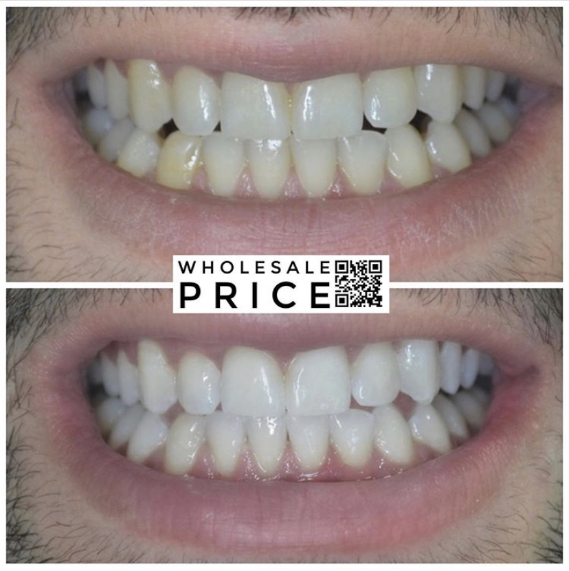 Teeth whitening korea price